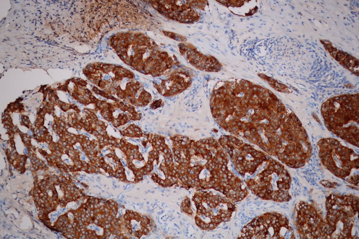 Synaptophysin-Färbung auf neuroendokrinem Tumor.