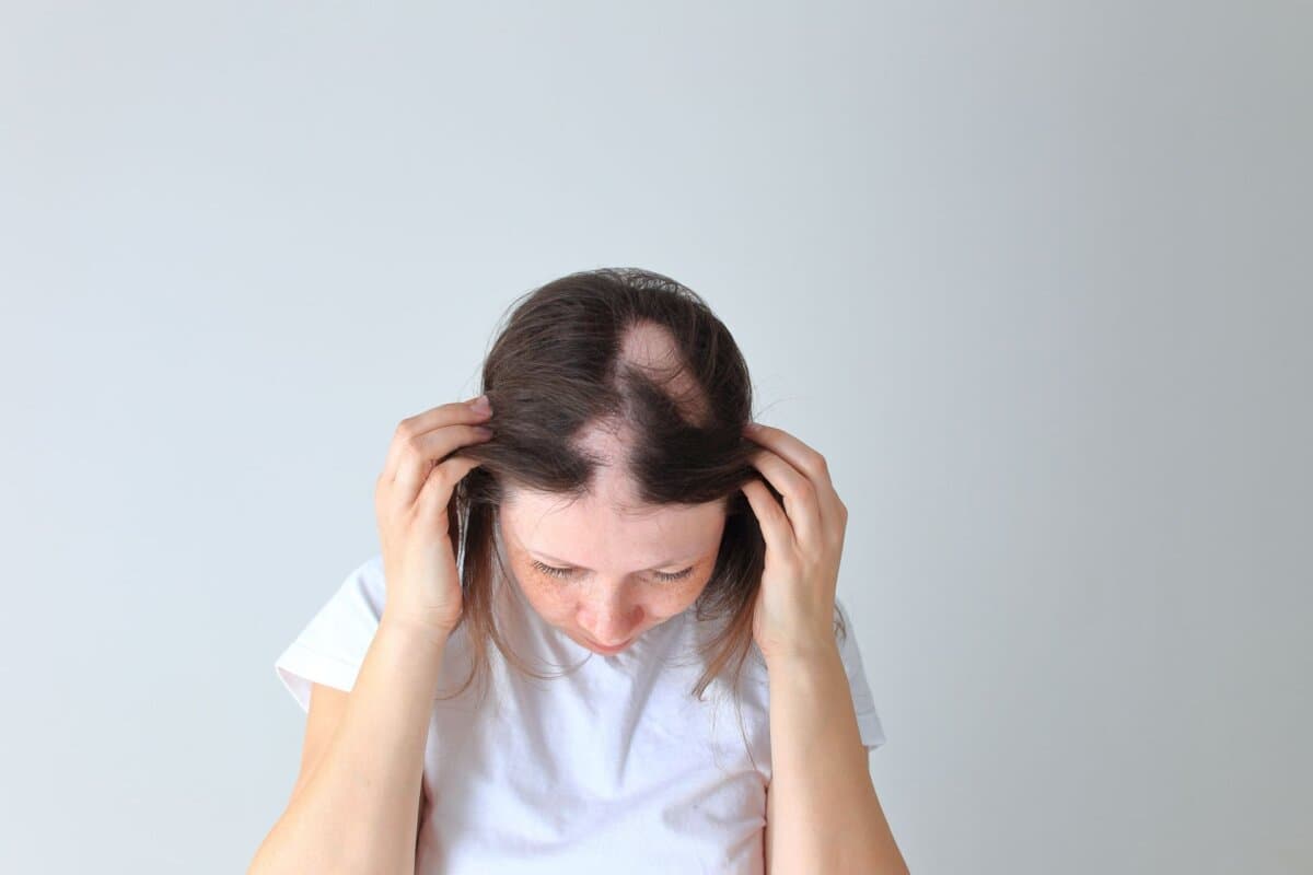 Wird Baricitinib abgesetzt, kommt es bei der Alopecia areata meist zum Rückfall.