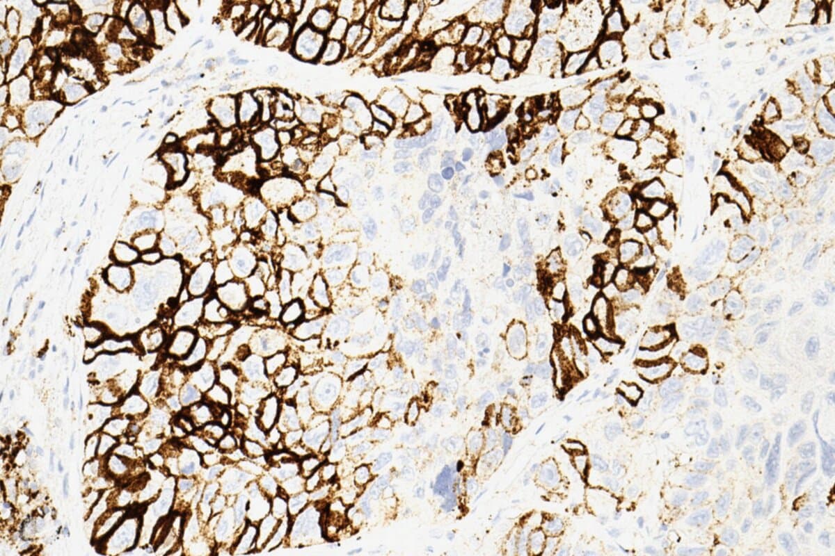 Positive Färbung des Biomarkers PD-L1 auf einem Schnitt eines nichtkleinzelligen Lungenkarzinoms.