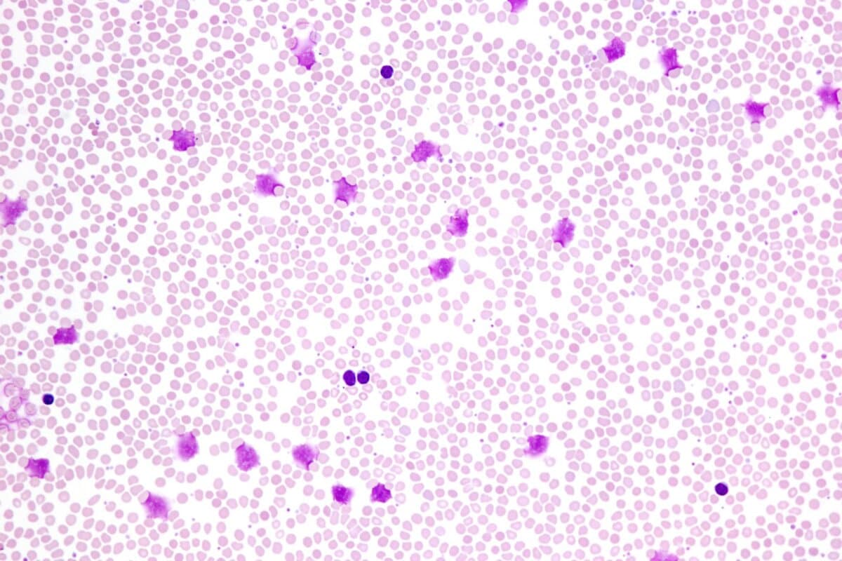 Acalabrutinib plus Venetoclax könnten zum neuen Erstlinienstandard bei der CLL werden.