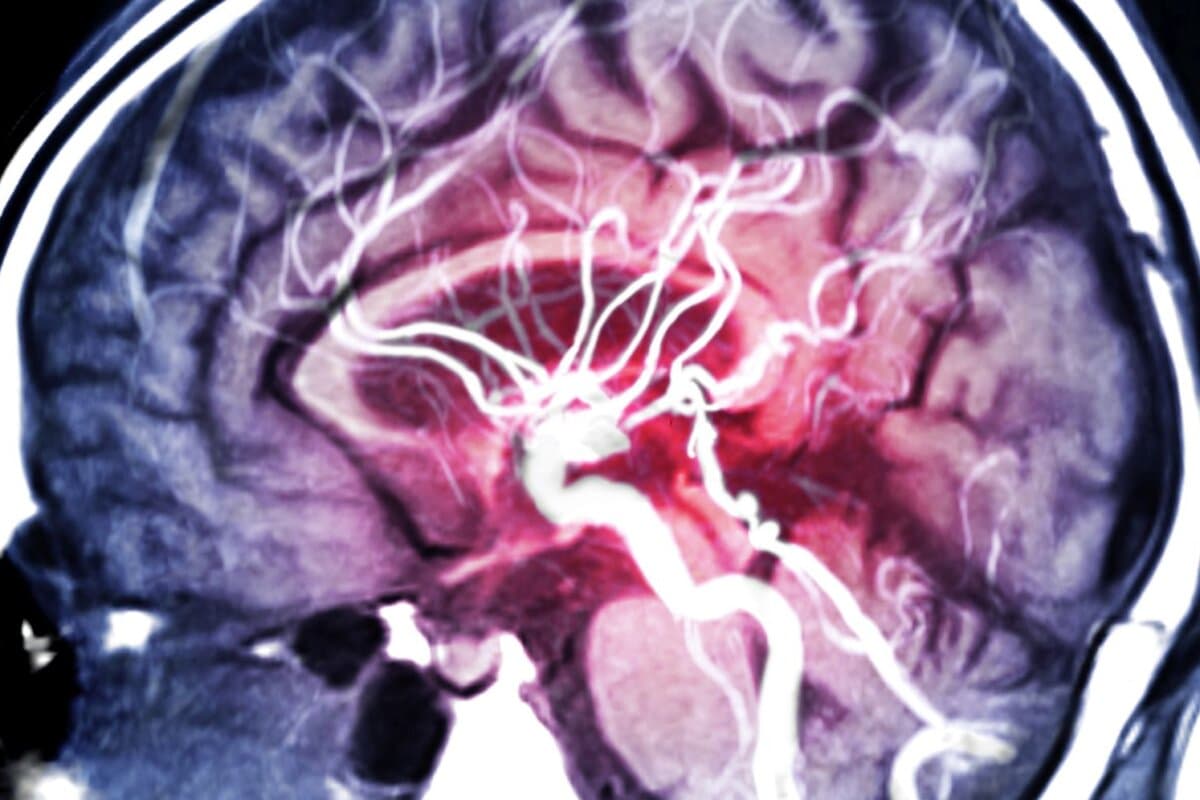 ARM du cerveau ou angiographie par résonance magnétique (IRM) des vaisseaux cérébraux en vue sagittale pour évaluer une sténose.