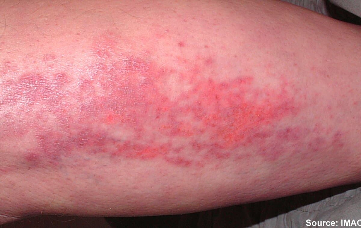 Bei der Dermatomyositis kommt es zu typischen Hautveränderungen und einer fortschreitenden Muskelschwäche.
