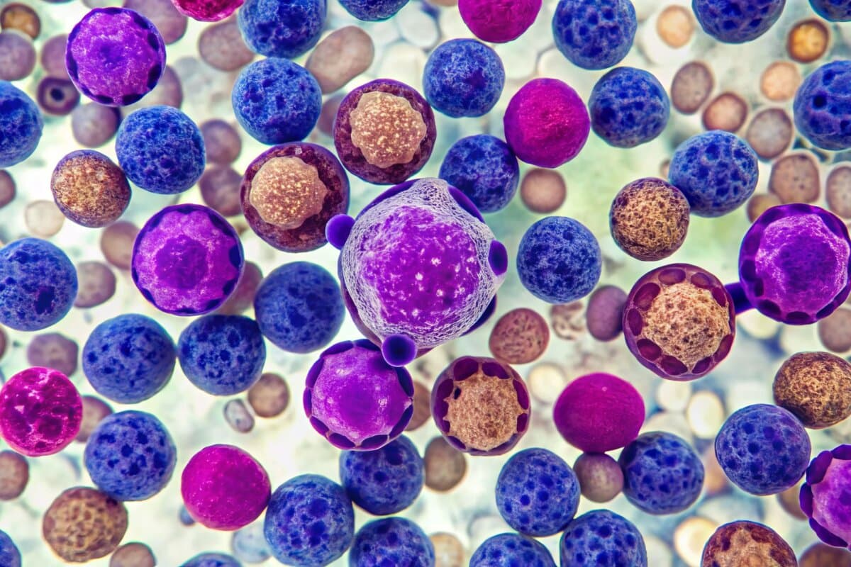 Bei Patienten unter 65 Jahren mit Mantelzell-Lymphom kann man wahrscheinlich auf die ASCT verzichten.