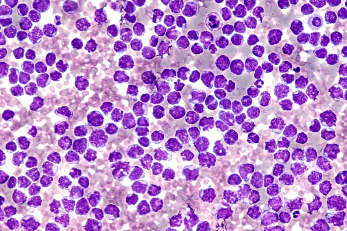 Eine Real-World-Studie untersuchte Pirtobrutinib in einer realistischen Patientenkohorte mit Mantelzelllymphom.