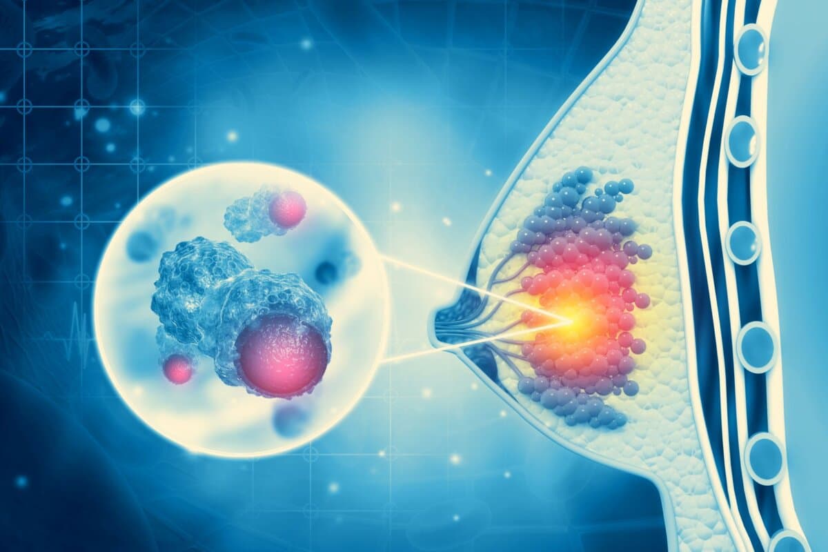 In der Studie Ember-3 erzielte Imlunestrant vielversprechende Ergebnisse beim ER+/HER2- Mammarkazinom.