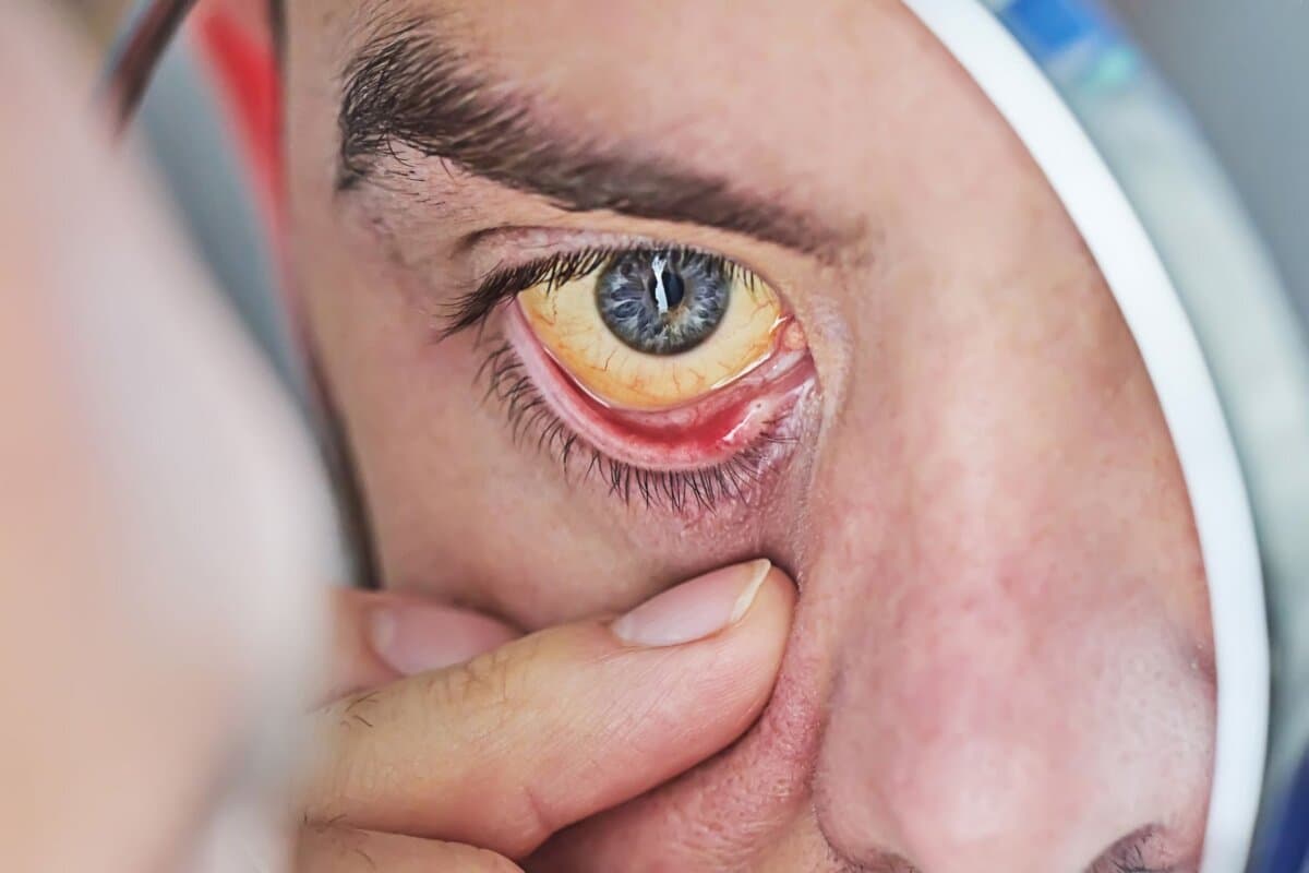 Œil humain avec un globe oculaire jaune, gros plan. Les yeux jaunes sont un symptôme d'une maladie du foie ou d'une hépatite.
