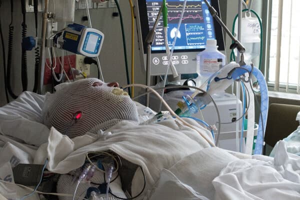 Patient en soins intensifs avec nécrolyse épidermique toxique.
