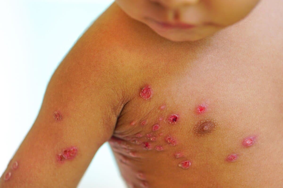 Von Ausbrüchen der Mpox Klade I sind oft Kinder betroffen.