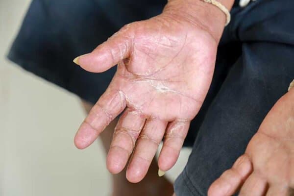 Main masculine avec Trouble de la peau, aspect poivré de la sclérodermie, maladie auto-immune