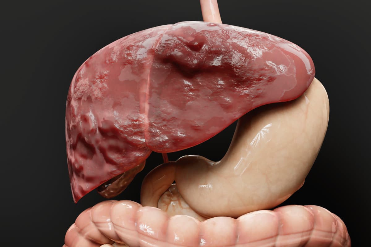 Teilnehmende hatten median zwölf Lebermetastasen eines CRC, aber keine Filiae in anderen Organen.