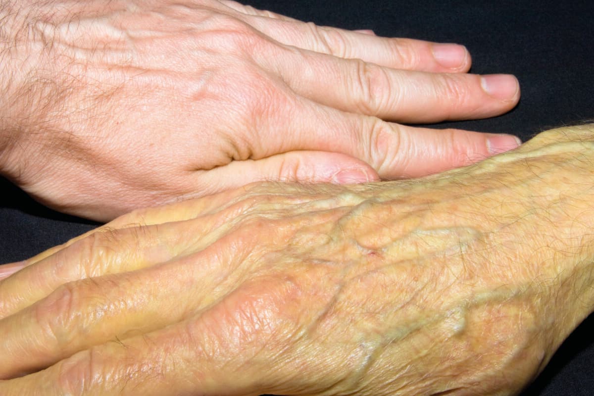 MODEL RELEASED. Jaundice. 81-year-old man's hand (bottom) exhibiting jaundice as a result of taking the antibiotic Augmentin to treat a sinus infection. A normal person's hand is seen at top for comparison. Jaundice is a condition in which the skin and eyes are discoloured due to the deposition of excess bilirubin (pigment) in skin tissues. Jaundice is not a disease in itself,but is a symptom of m