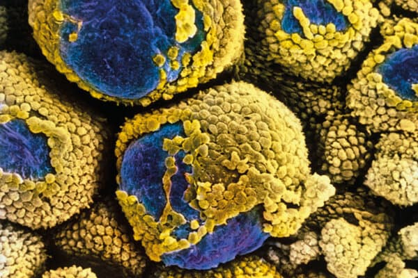 MEB en fausses couleurs de l'ovaire polykystique