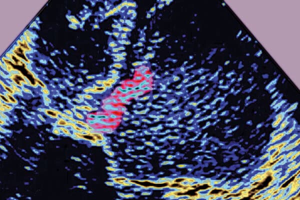 Endocardite Échocardiographie