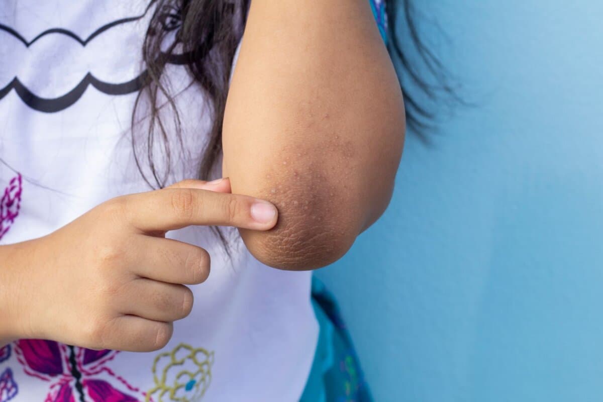 Bei dunkler Haut erscheinen viele Dermatosen anders als bei heller.