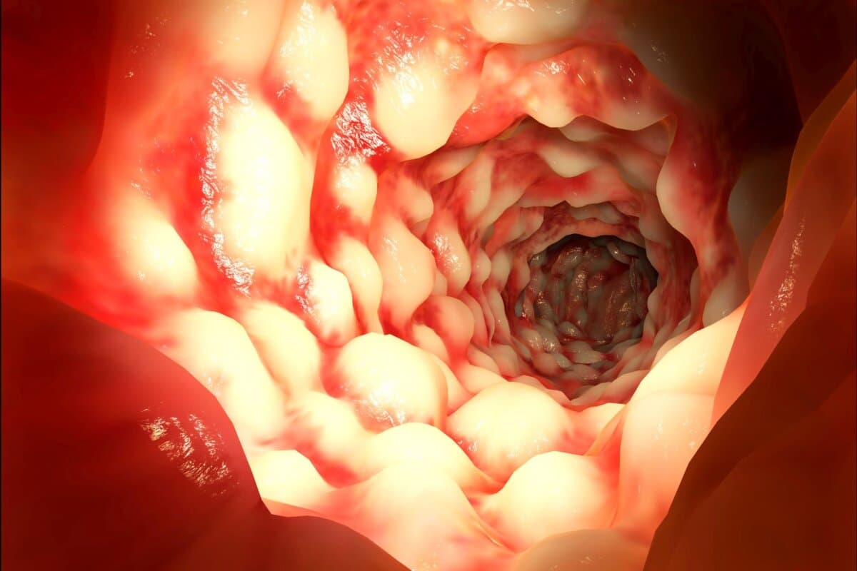 Der JAK-Inhibitor Filgotinib war in einer Studie langfristig wirksam beim Morbus Crohn.