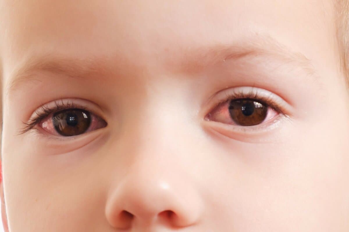 Hinter roten Augen können bei Kindern viele Ursachen stecken.