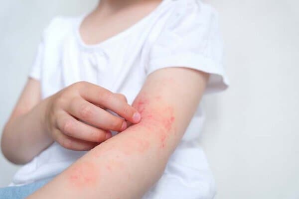 Enfant méconnaissable se grattant le bras avec une dermatite atopique.