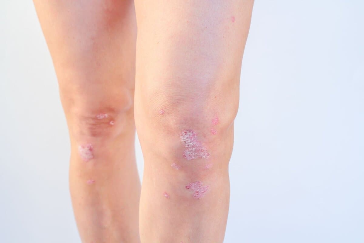 Les donnees fiables manquent encore pour savoir si un traitement contre le psoriasis permet de prevenir les manifestations articulaires.