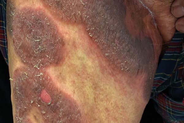 Patient zeigt kutanes T-Zell-Lymphom an den Beinen.