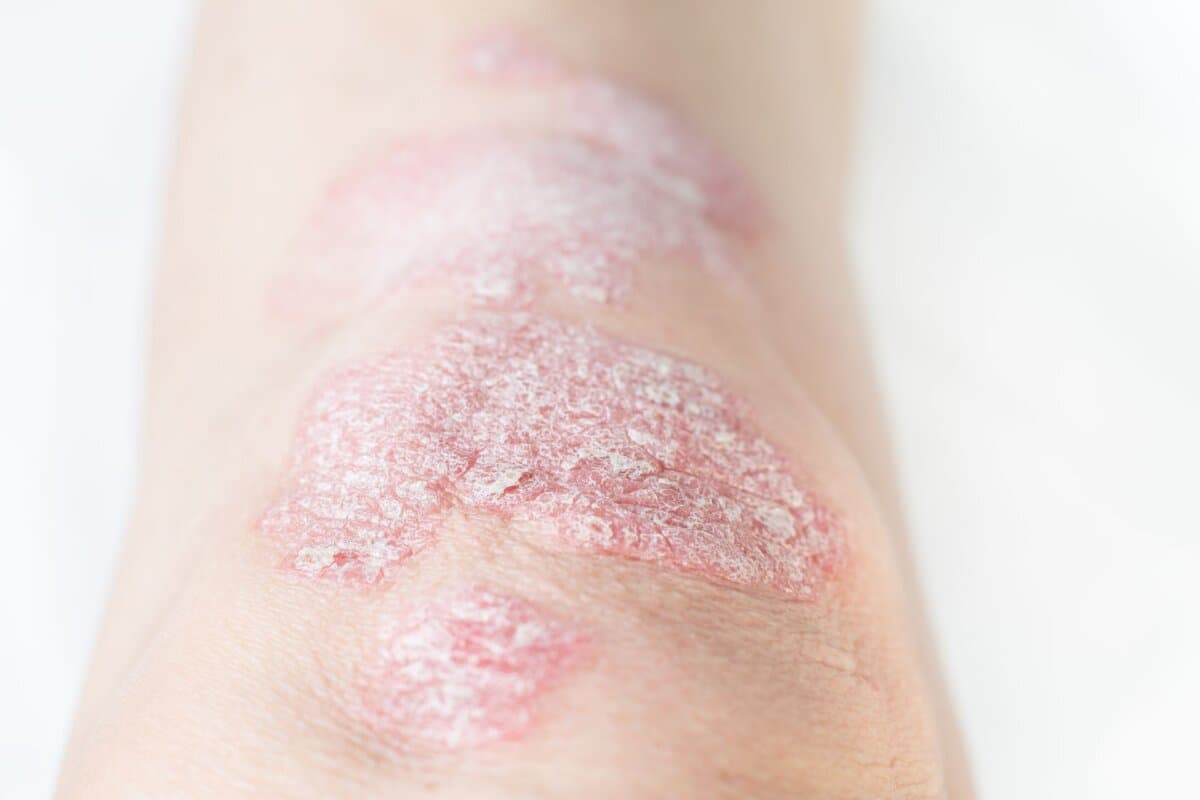 Eine Biologikabehandlung schützte in einer Metaanalyse Psoriasis-Patianten vor weiteren kardiovaskulären Ereignissen.