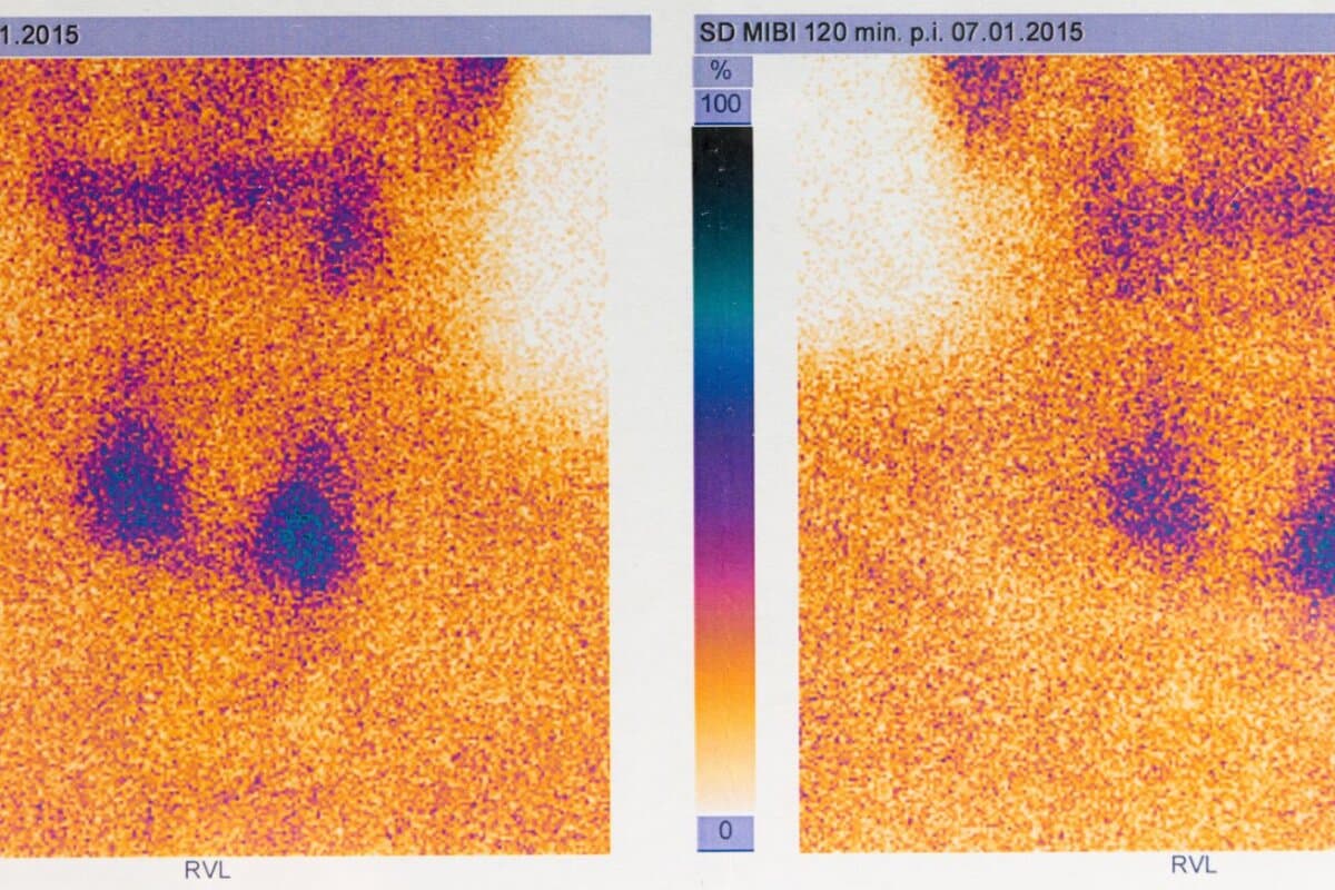 Scintigraphie d’une thyroïde avec des nodules froids