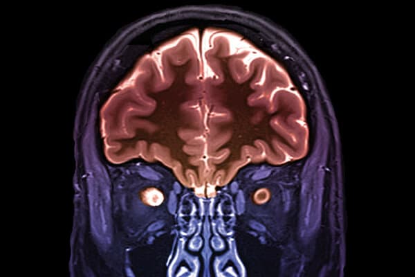 Scan IRM d'un nerf optique avec sclérose en plaques comme symptôme