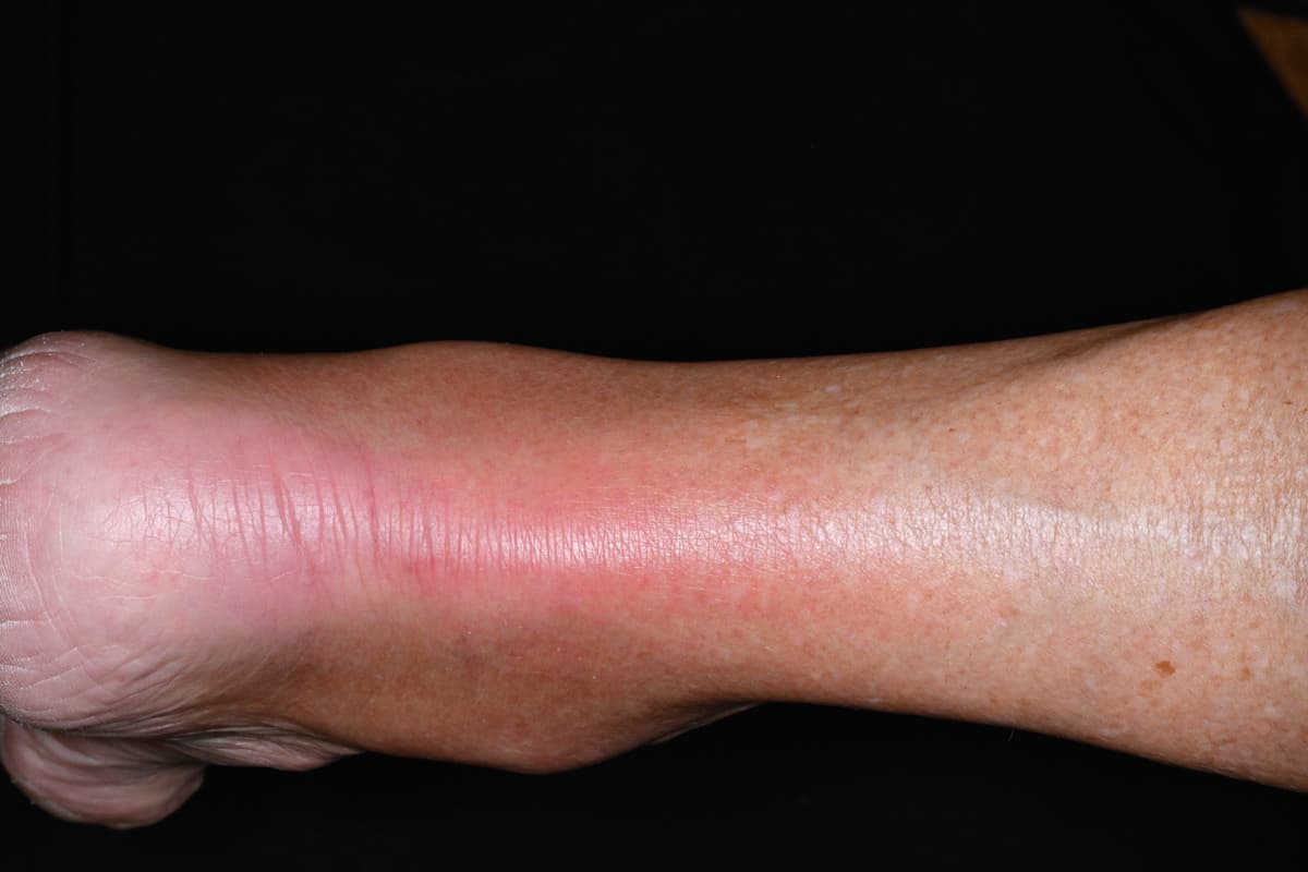 Achillessehnen-Tendinopathie bei einer Patientin