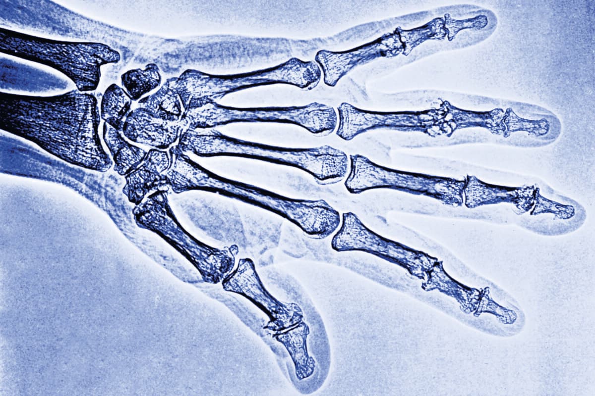 Radiographie en couleur d'une arthrite affectant les articulations de la main.