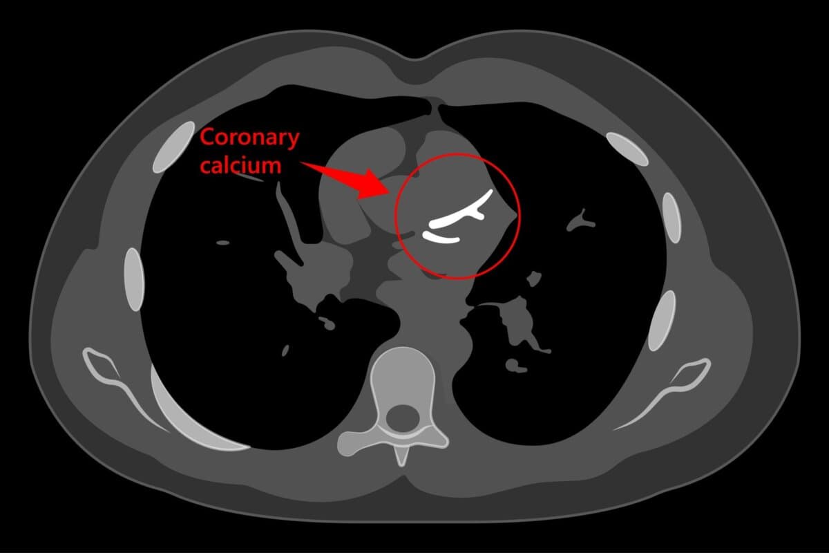 Der Kalzium-Score war in einer US-Studie altersunabhängig prognostisch.