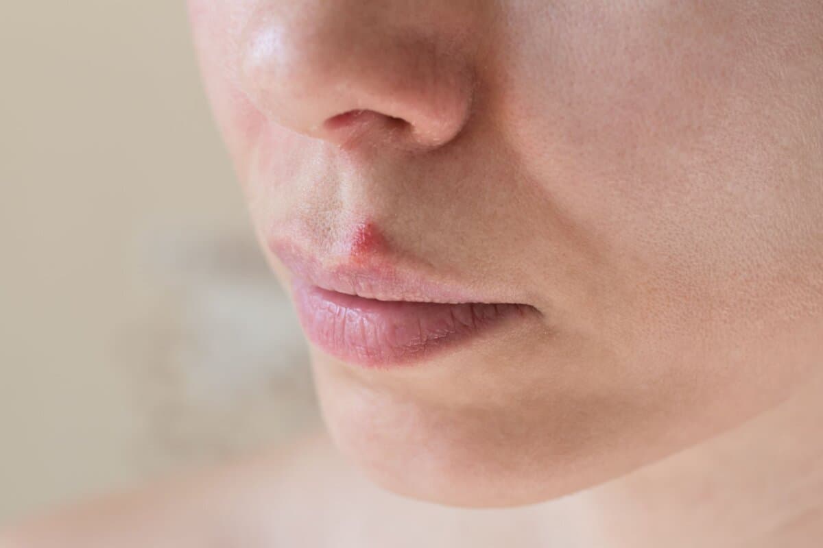 Lippenherpes, oder HSV-1-Infektion, war in einer Studie mit einem erhöhten Alzheimer-Risiko assoziiert.