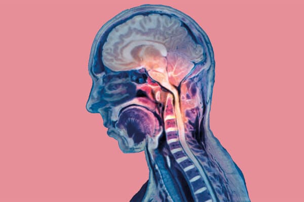 zervikale Wirbelsäule mit rheumatoider Arthritis