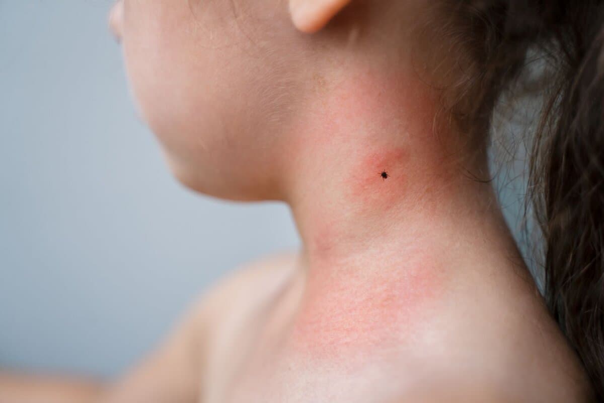Die Borreliose zeigt je nach Alter des betroffenen Kindes unterschiedliche Symptome.