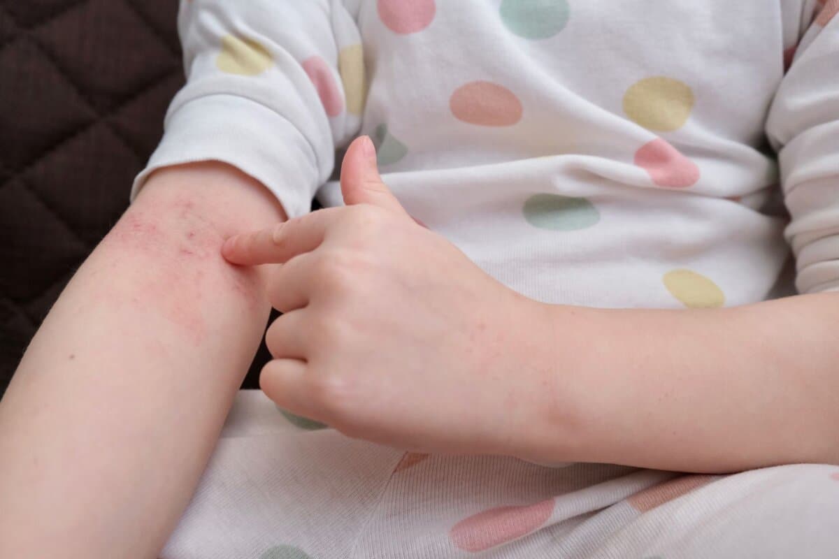 Das therapeutische ARmamentarium für die atopische Dermatitis ist heutzuage wesentlich breiter als früher.