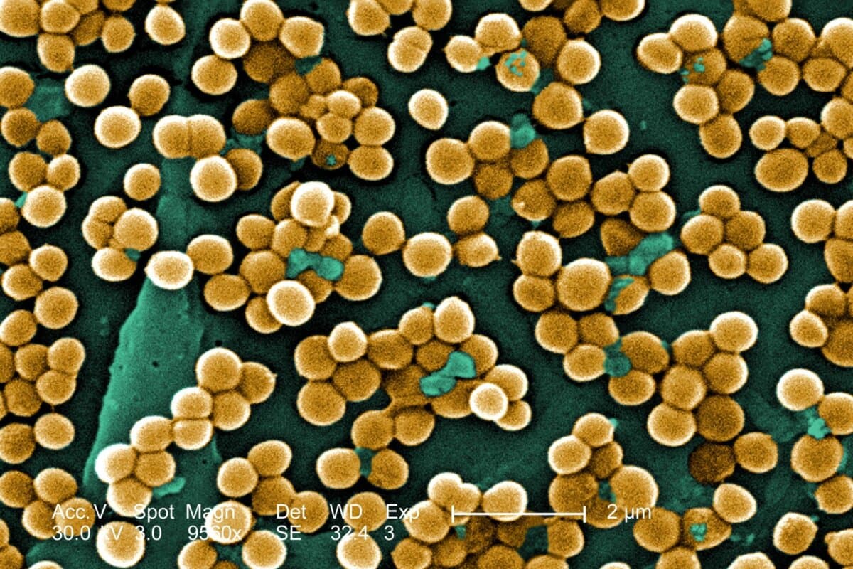 Le Staphylococcus aureus résistant à méticilline (SARM) est une cause fréquente d'infections cutanées bactériennes.