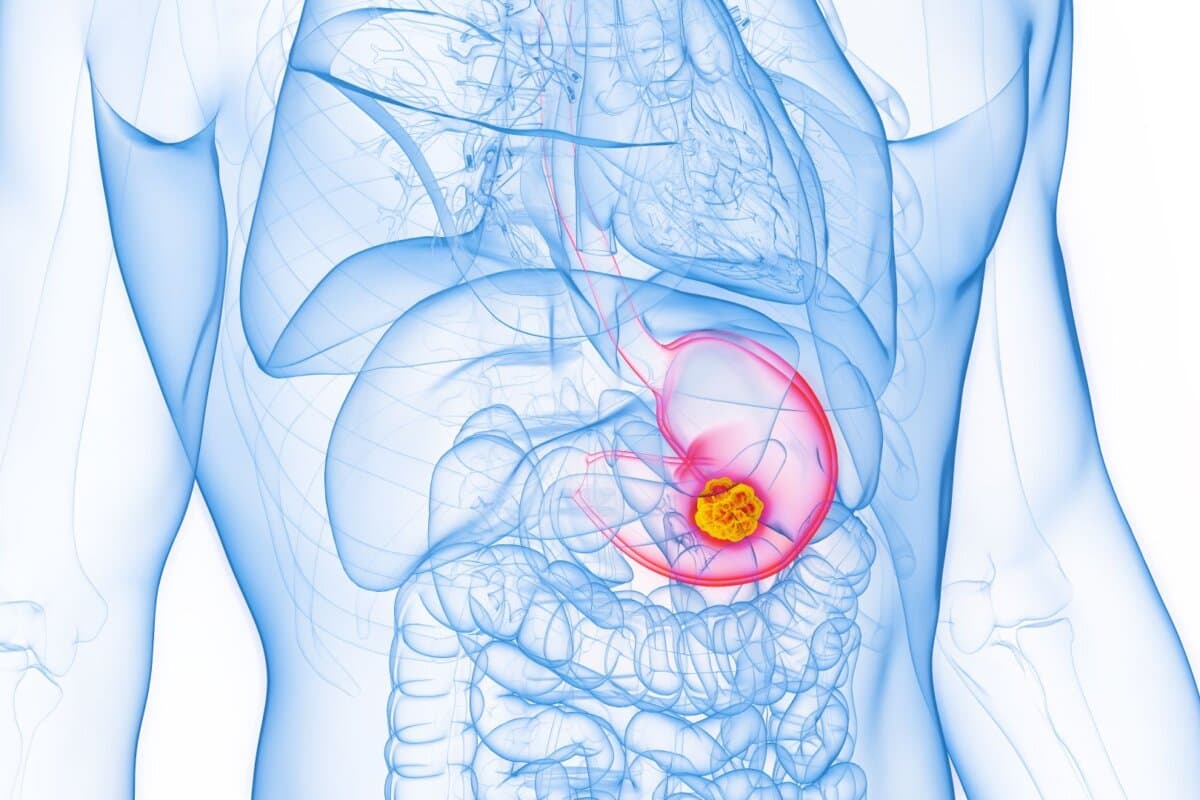 3D-gerenderte medizinische Illustration der männlichen Anatomie - Magenkrebs. Einfacher weißer Hintergrund.