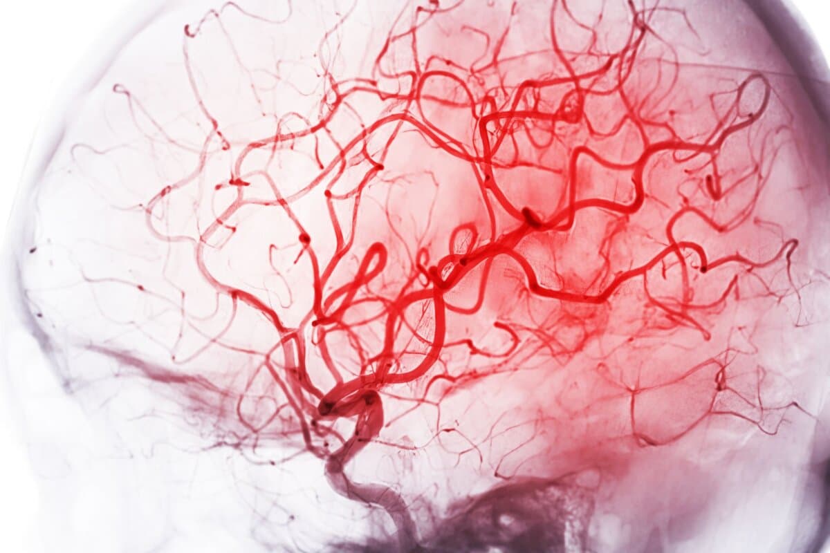Bild einer zerebralen Angiographie aus der Fluoroskopie in der interventionellen Radiologie, das die Hirnarterie zeigt.