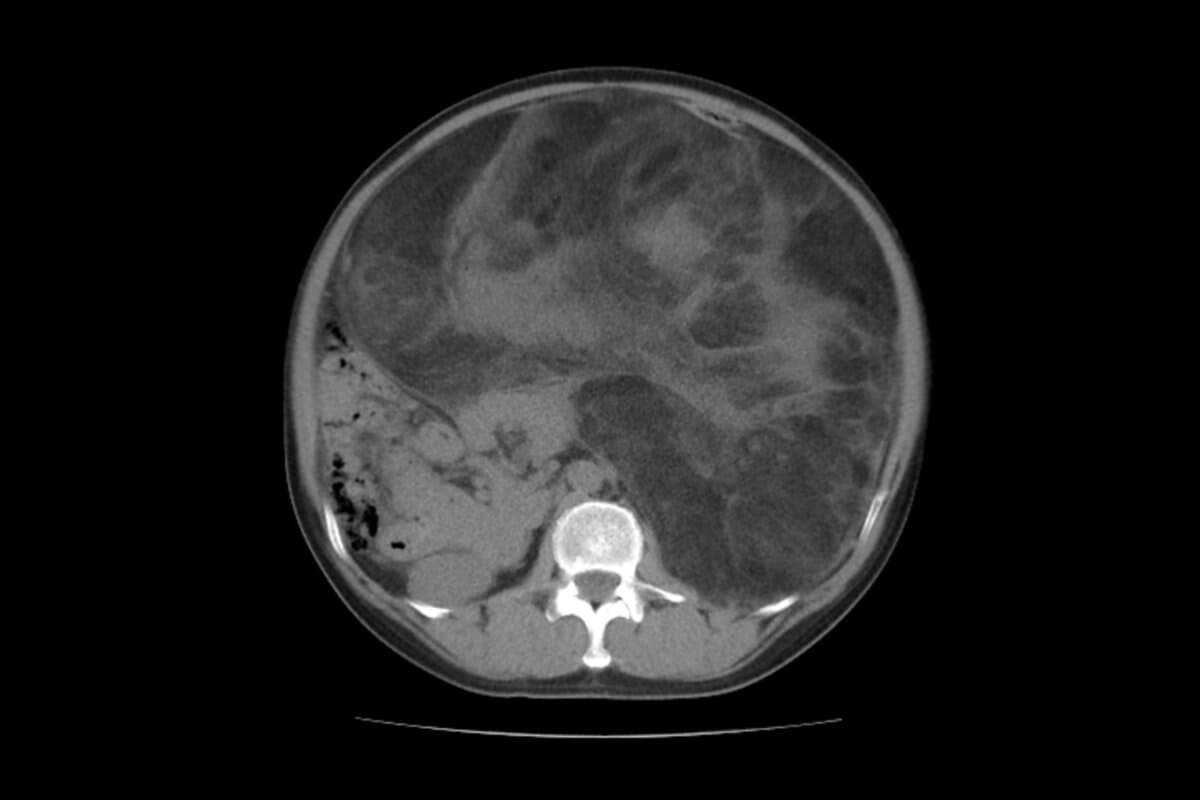 Liposarkom im Bauchraum, CT-Scan