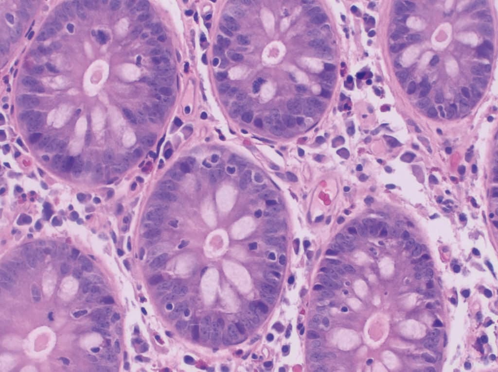 MTCH_2025_KW44_Gastro3_Histopathology_of_lymphocytic_colitis