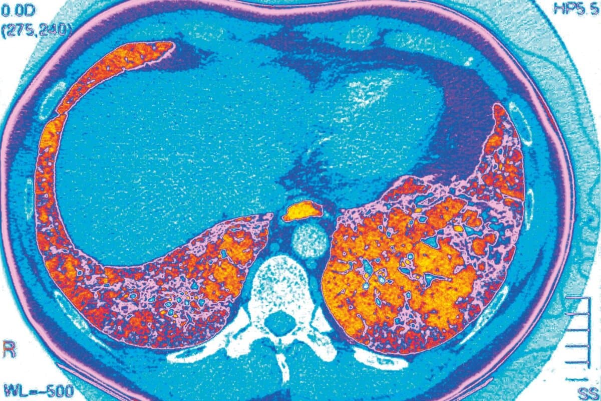 Scanner thoracique montrant une insuffisance respiratoire due à une fibrose pulmonaire interstitielle diffuse, terme désignant un groupe de maladies caractérisées par une inflammation et une cicatrisation pulmonaires.