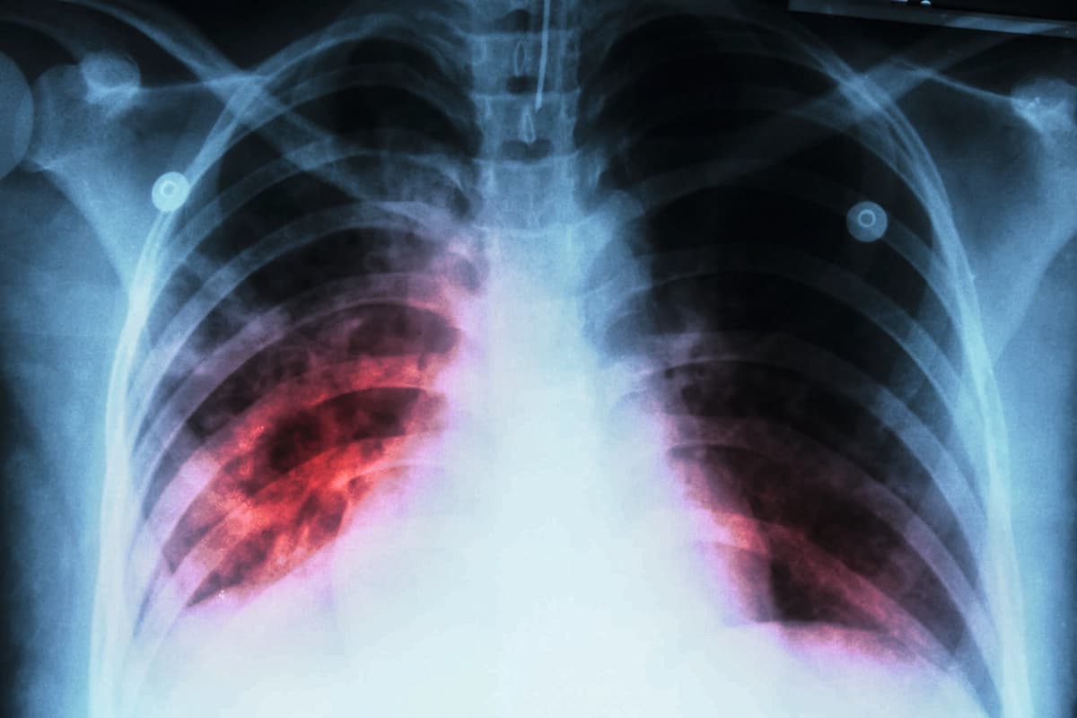 Lungentuberkulose (TB): Röntgenaufnahme des Brustkorbs zeigt alveoläre Infektion