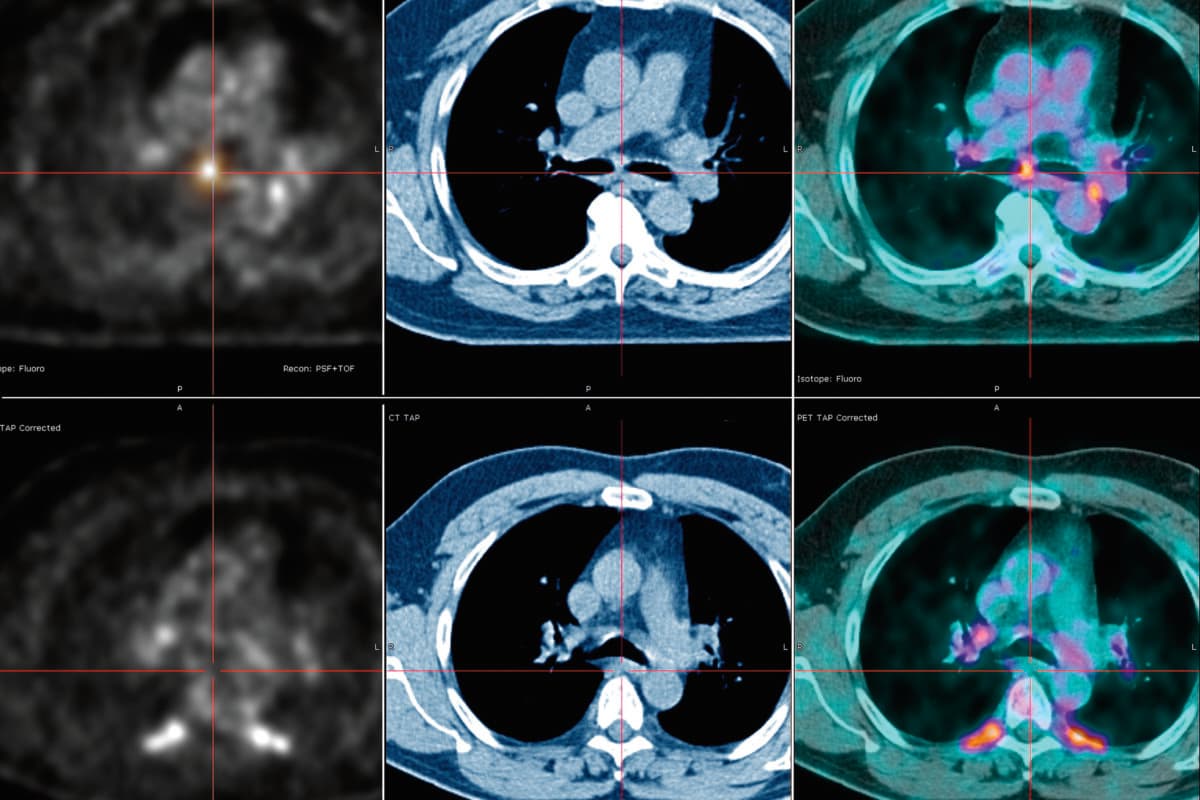 Chronisch atrophische Polychondritis, PET- und CT-Scans