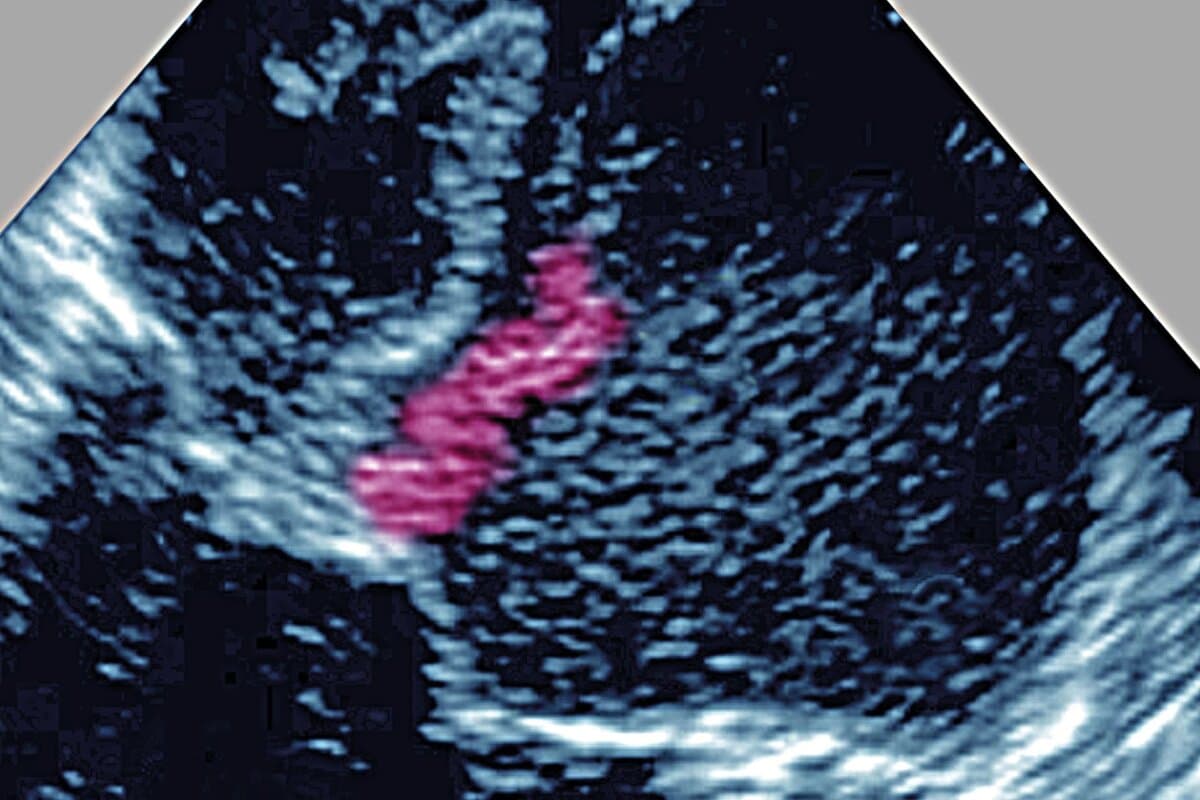 In der Echokardiografie zeigt sich eine infektiöse Endokarditis der Mitralklappe.