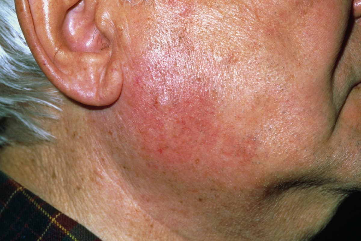 Entzündete Ohrspeicheldrüse bei einem 78-jährigen Mann mit Parotitis.