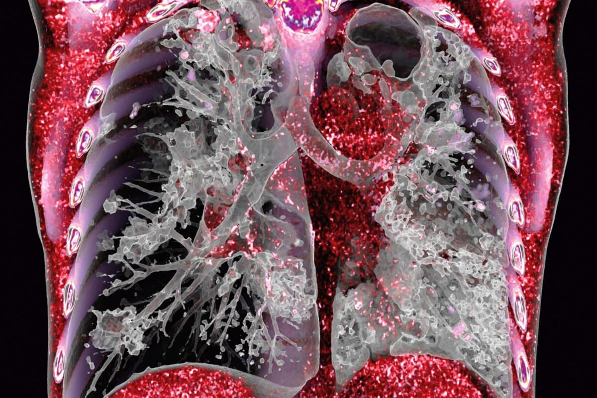 Eine dreidimensionale CT-Aufnahme zeigt typische entzündliche und strukturelle Veränderungen der Lunge bei Tuberkulose.