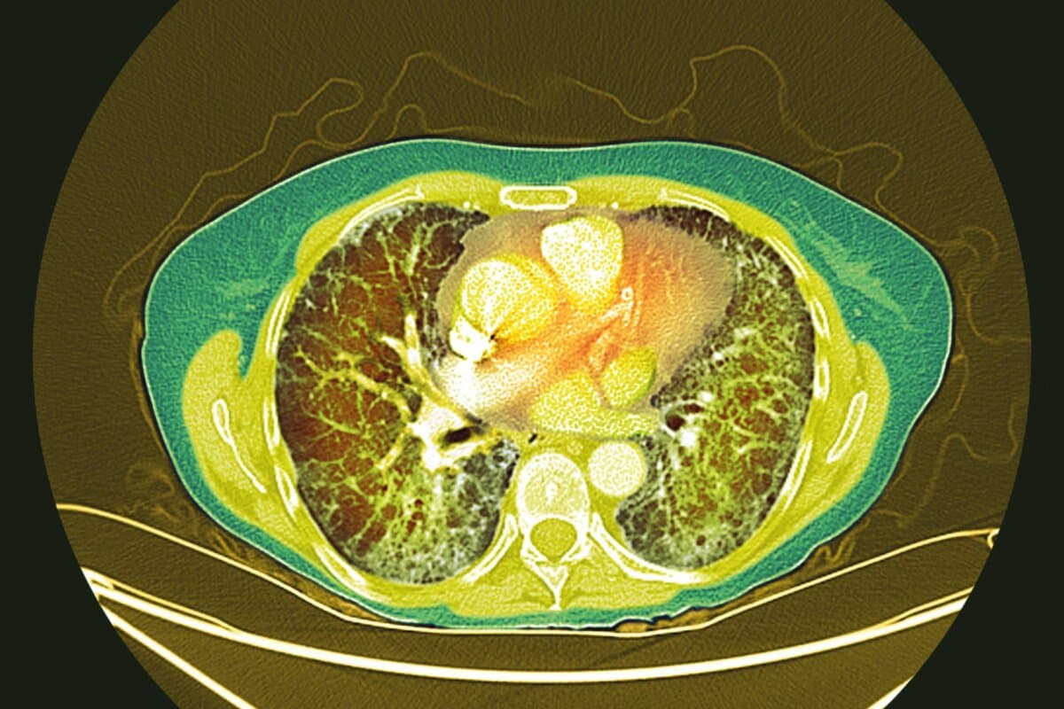 Farbkodierte CT-Aufnahme mit typischen fibrotischen Veränderungen des Lungenparenchyms.