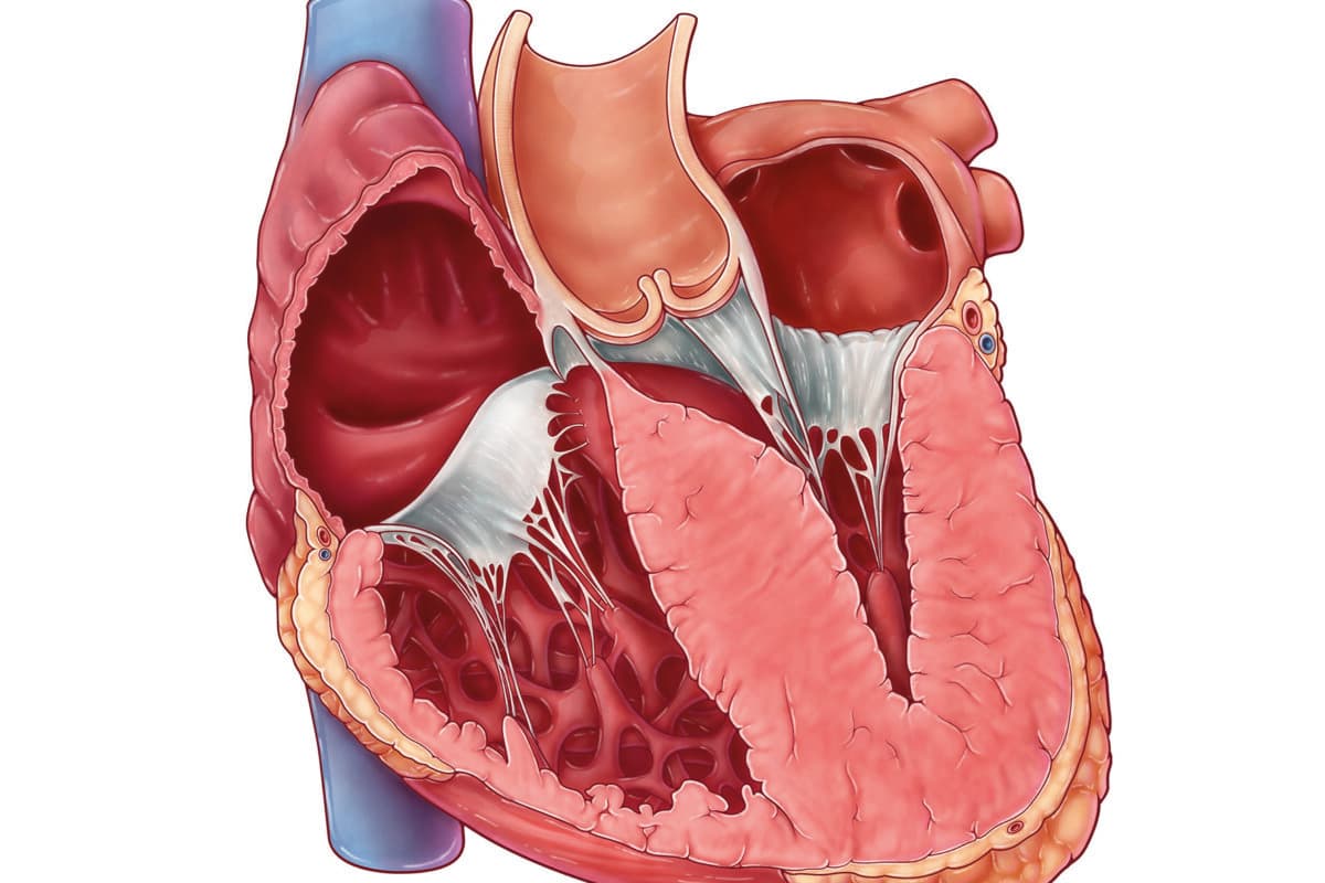Illustration der hypertrophen Kardiomyopathie: Verdickte Ventrikelwände schränken die Füllung des Herzens ein.