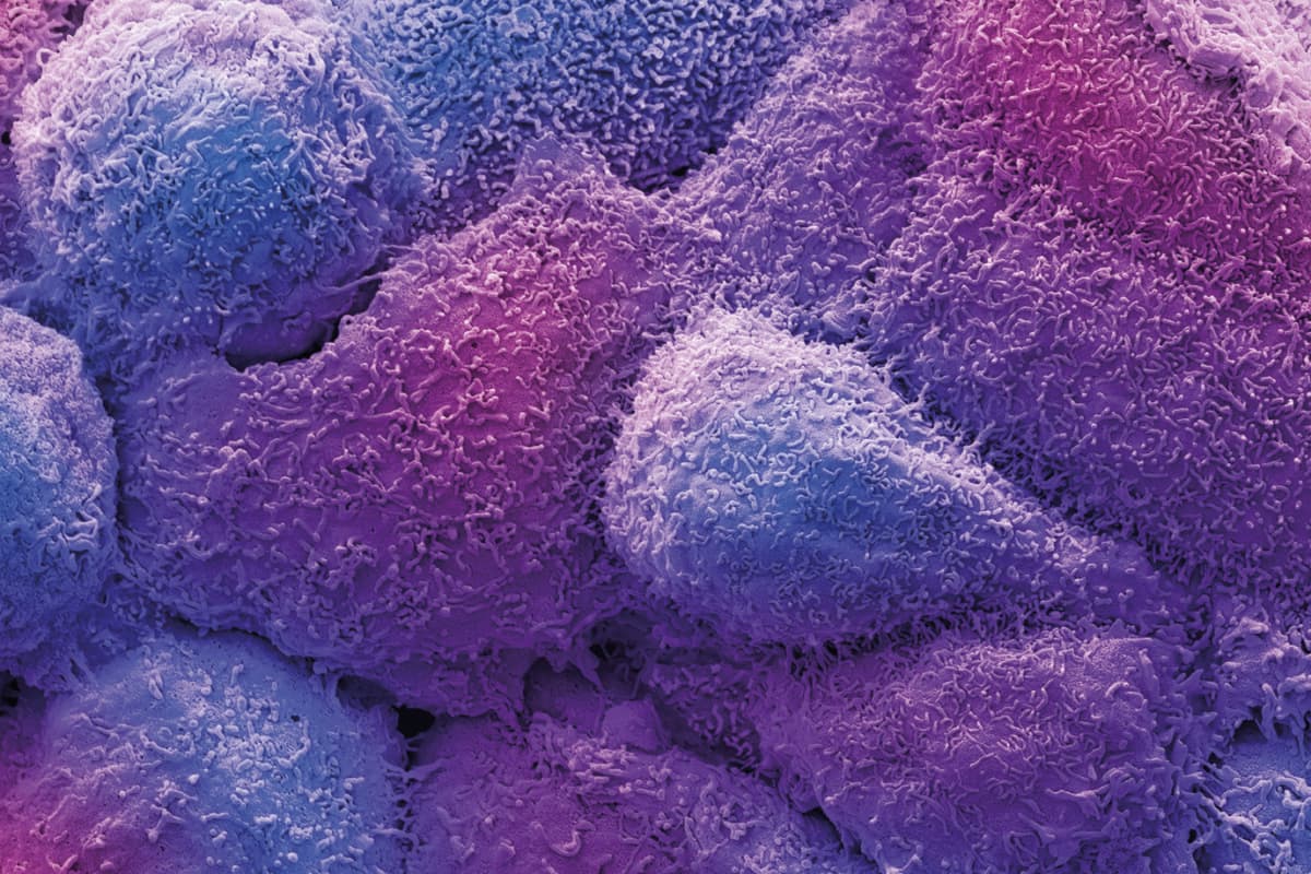 Rasterelektronenmikroskopische Aufnahme von Brustkrebszellen mit zahlreichen Zellfortsätzen und Mikrovilli, typisch für hochmobile, metastasierungsfähige Tumorzellen.