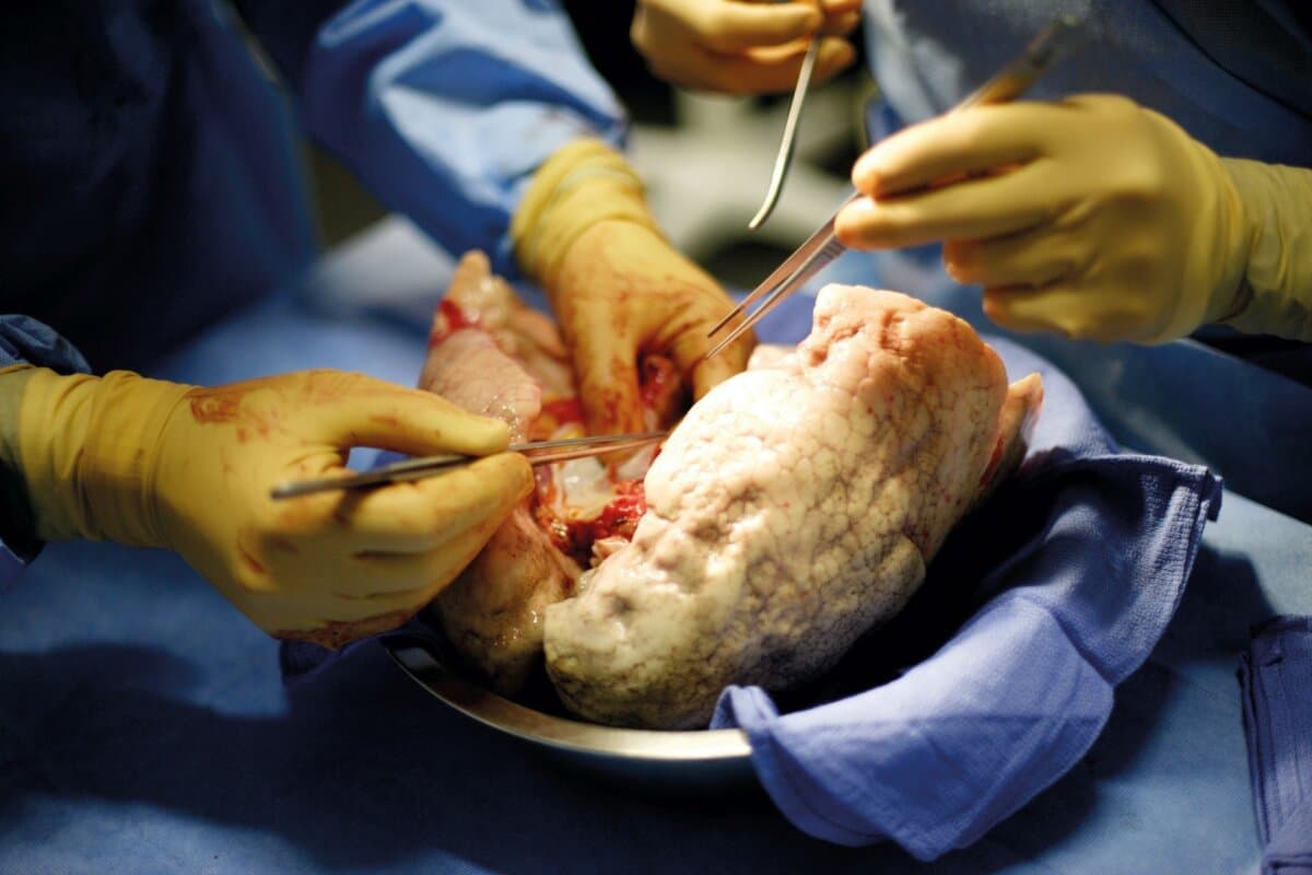 Chirurgisches Team bei einer bilateralen Lungentransplantation: Vorbereitung des Spenderorgans im OP.