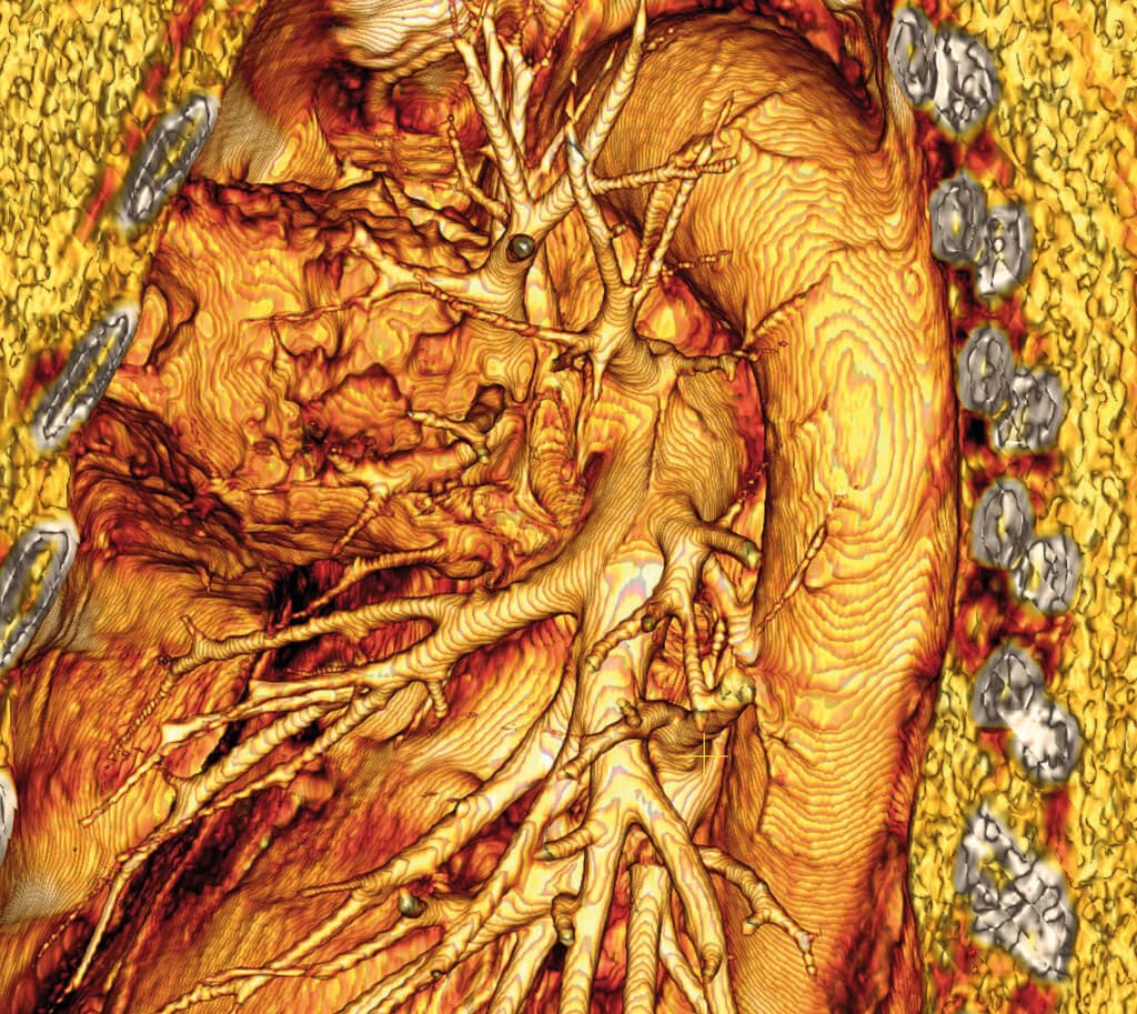 Lung cancer. Coloured 3D computed tomography (CT) scan of an area of the lungs affected by cancer. This view of the upper part of the left lung shows the cancer at upper left, extending into the chest wall. Branching lung airways are partially enclosed by the cancer. Part of the aorta is at right, and part of the heart is at lower left. Cancer cells divide in an uncontrolled fashion and migrate to