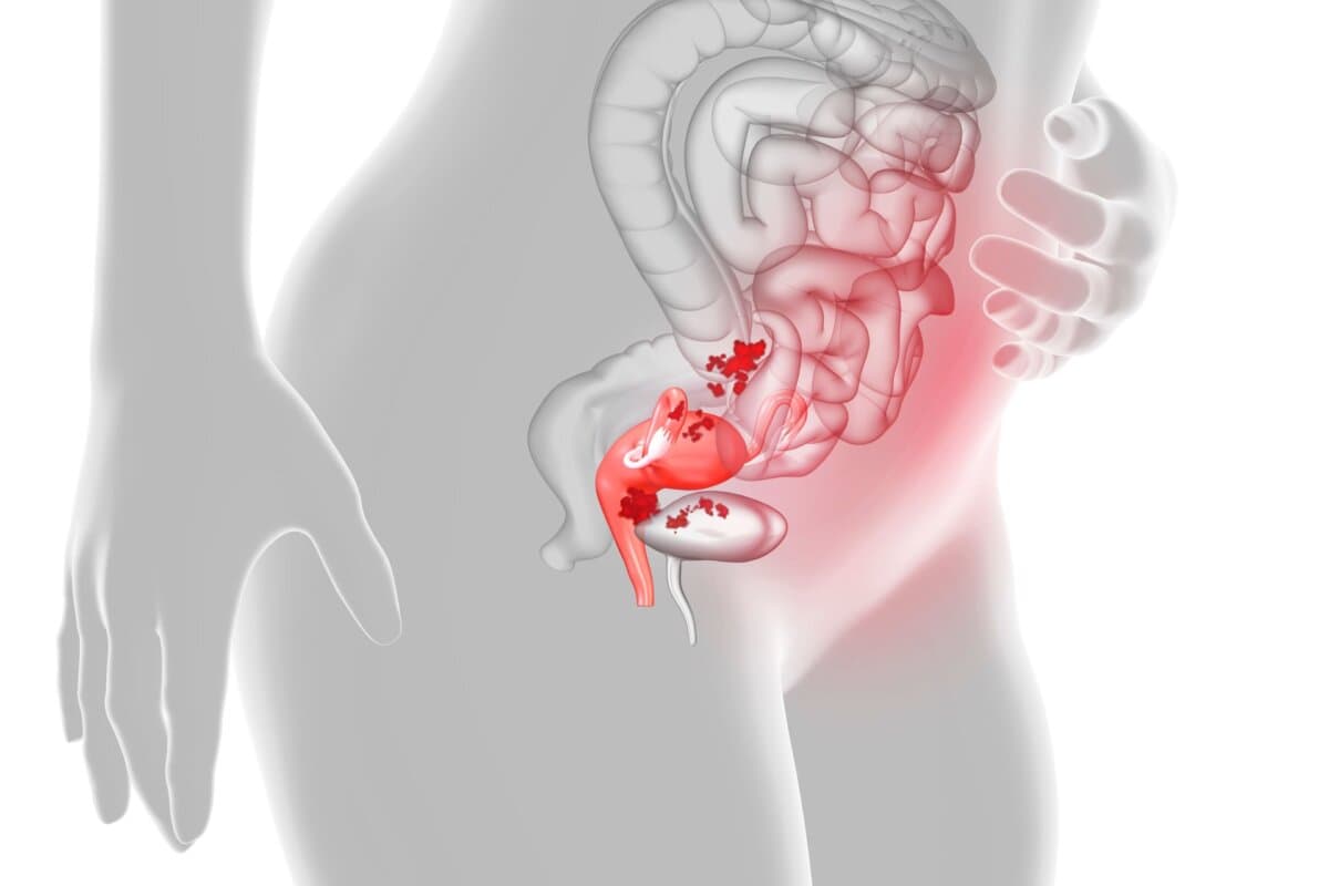 Schematische Darstellung von Endometrioseherden im weiblichen Becken.